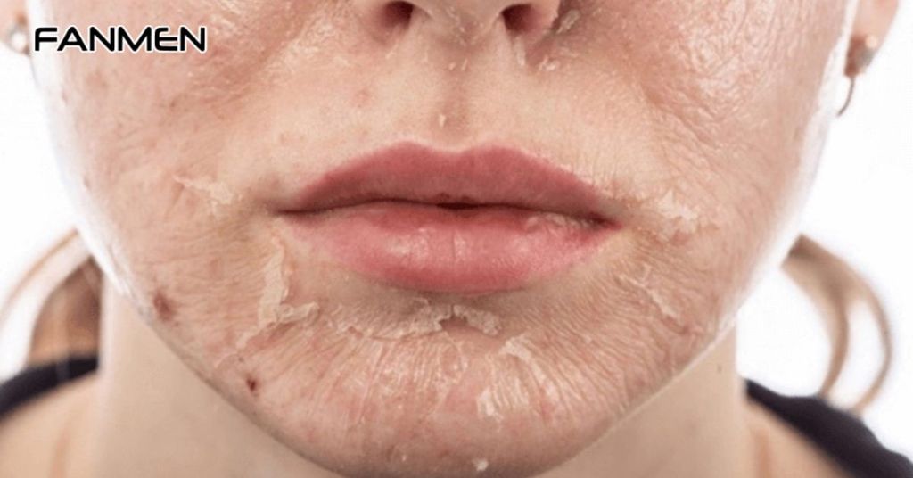 Cách trị mụn cám cho nam bằng phương pháp peel da