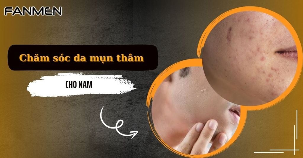 Chăm sóc da mụn thâm cho nam