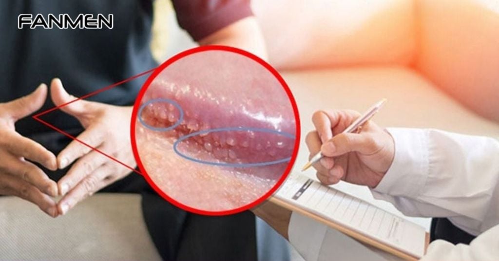 Chuỗi hạt ngọc dương vật