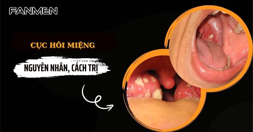 Cục hôi&nbsp;miệng