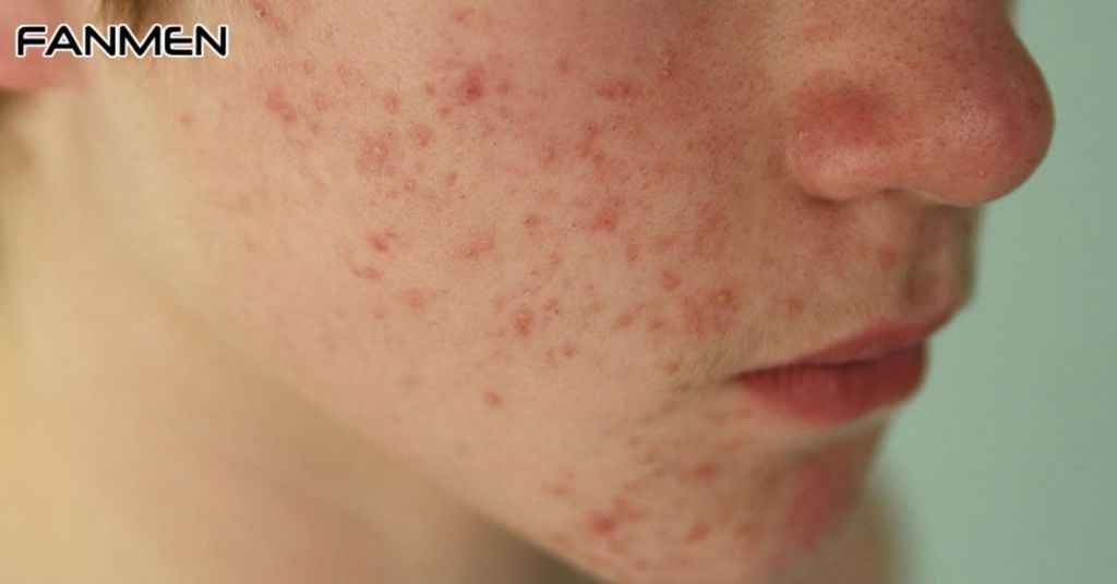 Da Dầu Mụn Có Nên Dùng Toner Không?