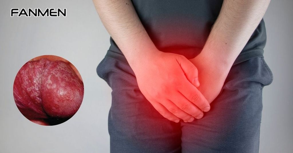 Dấu hiệu của bệnh nấm vùng kín nam giới