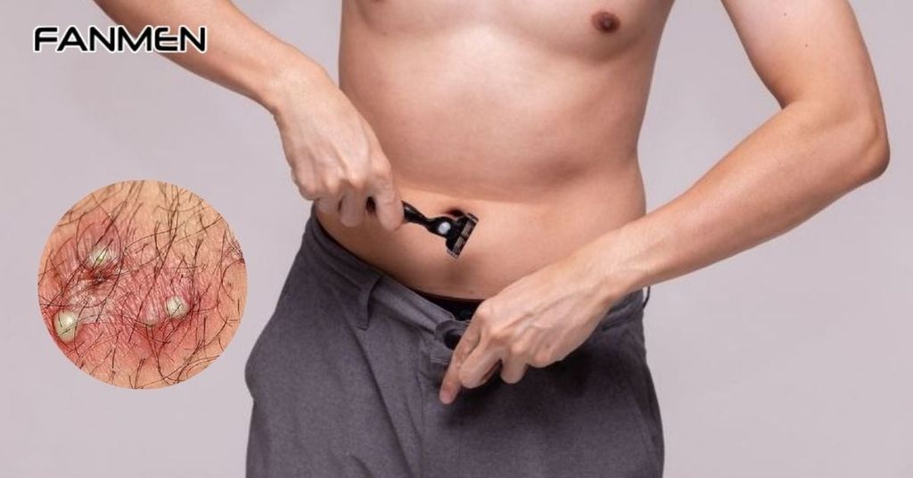 Dấu hiệu nhận biết viêm nang lông vùng kín nam do cạo lông