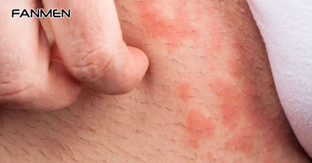 Dị ứng hoặc kích ứng