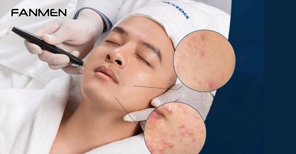 Điều trị mụn cho nam bằng công nghệ hiện đại