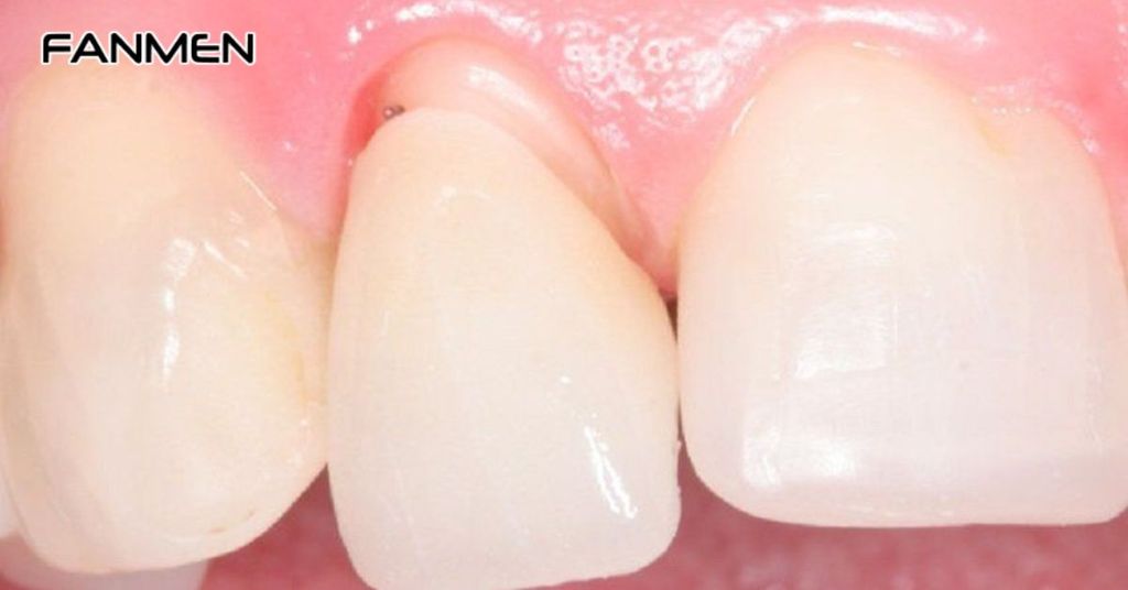 Do kỹ thuật thực hiện bọc răng không chuẩn xác