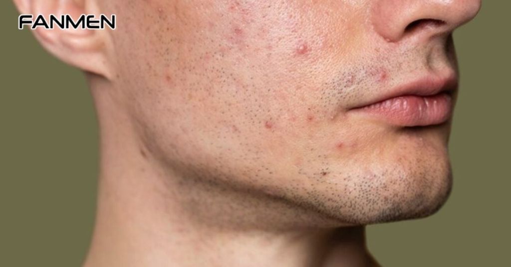 Lưu Ý Khi Áp Dụng Liệu Trình Điều Trị Mụn Cho Nam