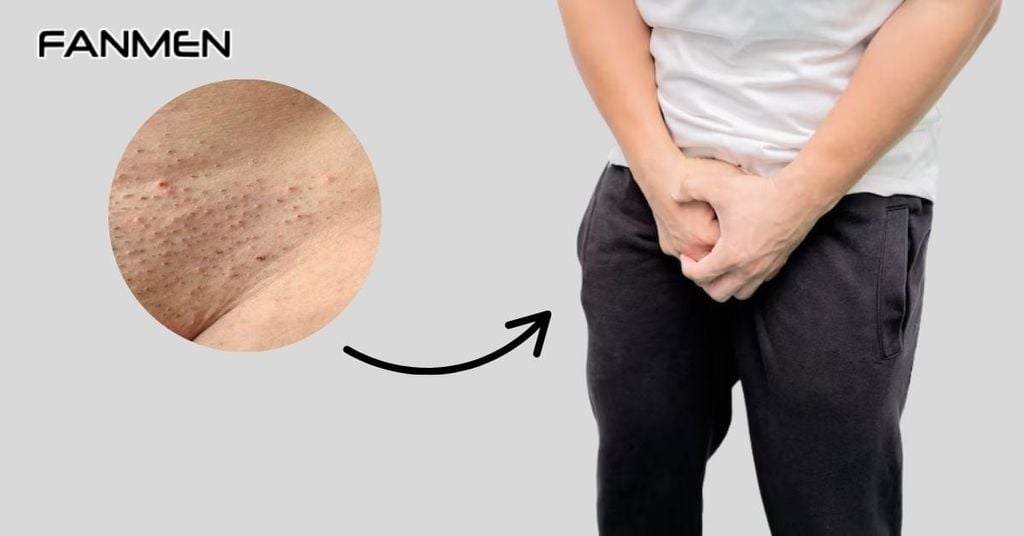 Nguyên Nhân Viêm Chân Lông Vùng Kín Ở Nam
