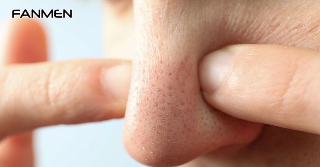 FAQ Về Mụn Cám Ở Mũi Nam