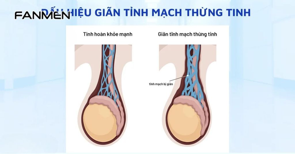 Giãn tĩnh mạch thừng tinh