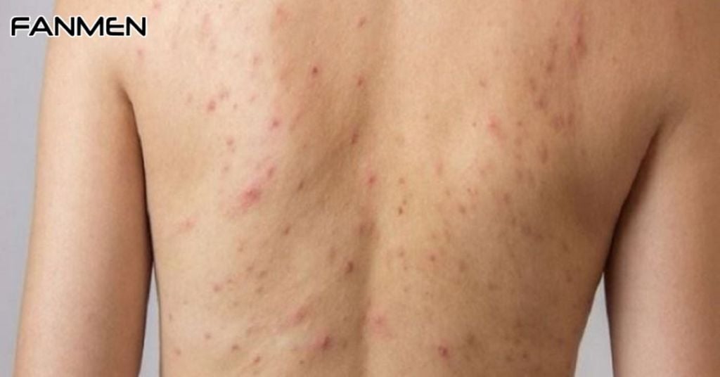 Nguyên Nhân Gây Ra Mụn Lưng Ở Nam Giới