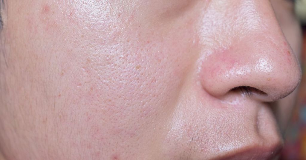 hệ lụy của da dầu