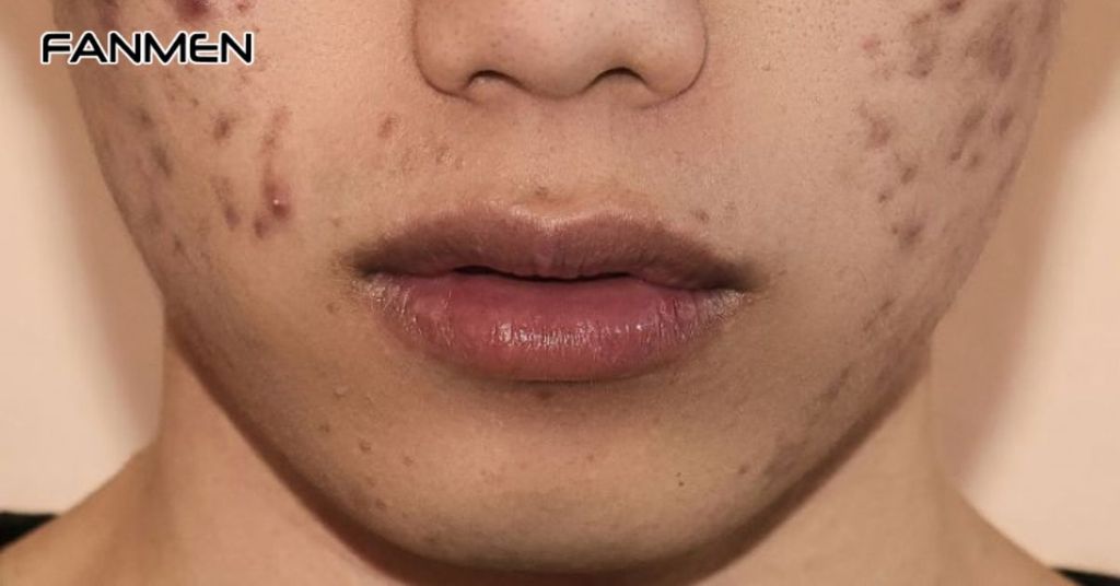 Lợi Ích Khi Sử Dụng Cây Thuốc Nam Trị Thâm Mụn