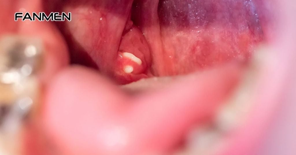 Hôi miệng do nguồn gốc ngoài răng miệng