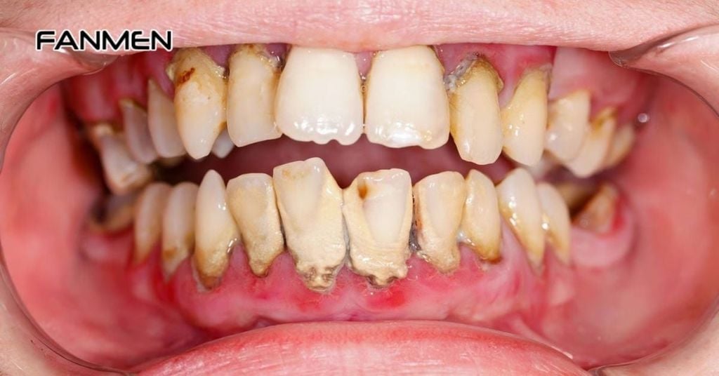 Nguyên nhân hôi miệng xuất phát từ miệng