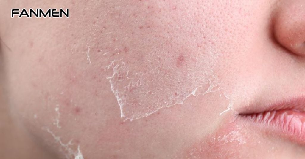 Điều trị sẹo bằng phương pháp lột da hóa học