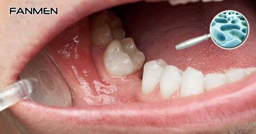 Tăng sinh vi khuẩn trong miệng và thực quản