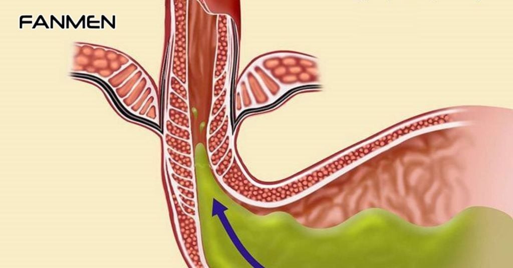 Kiểm soát trào ngược dạ dày