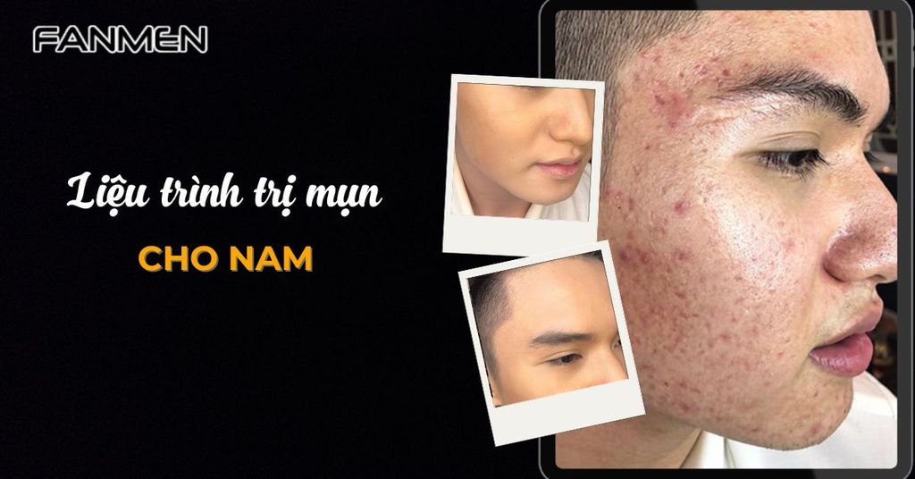 Liệu trình trị mụn cho nam