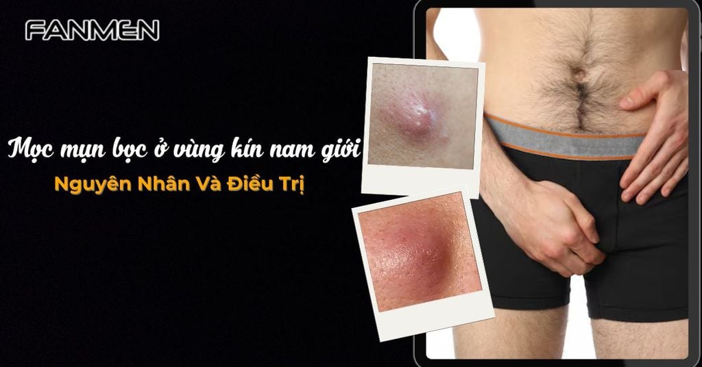Mọc mụn bọc ở vùng kín nam giới