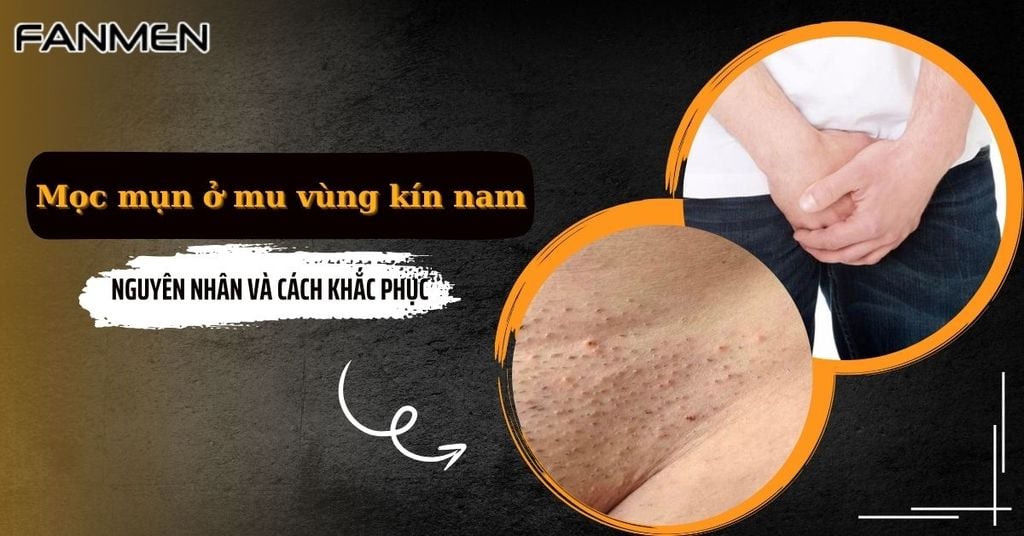 Mọc mụn ở mu vùng kín nam