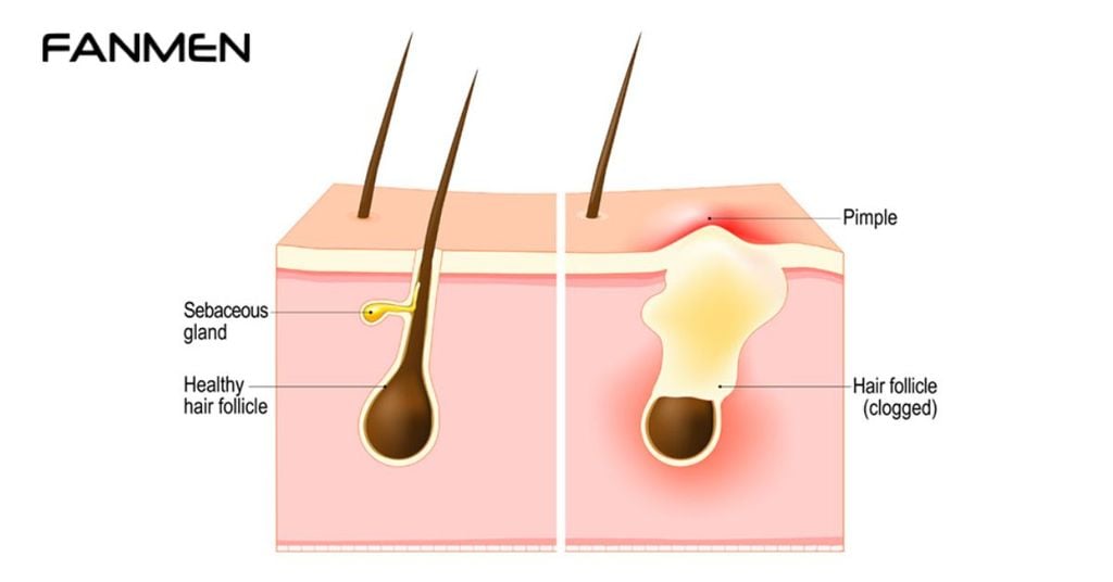Nguyên Nhân Mọc Mụn Trứng Cá Ở Vùng Kín Nam Giới