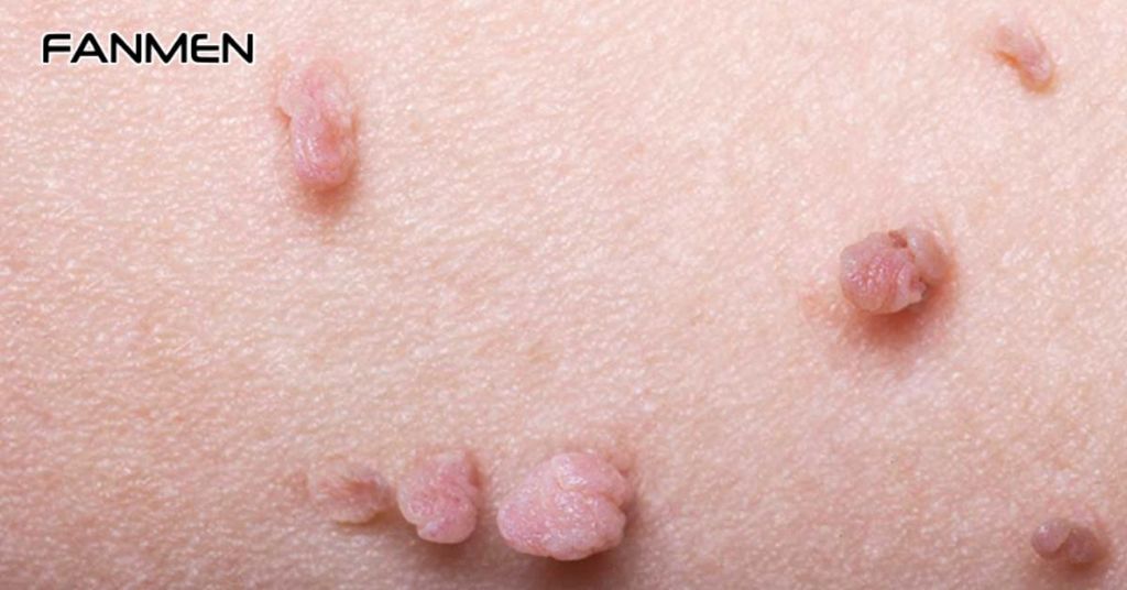 Mụn cóc sinh dục