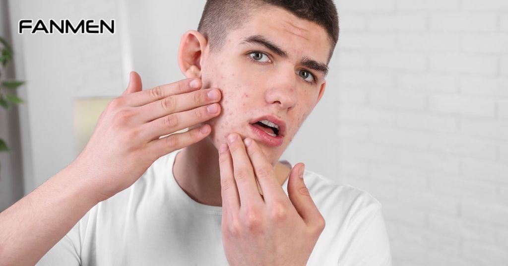 Nổi nhiều mụn khi đã qua tuổi dậy thì