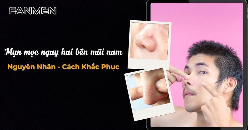 Mụn mọc ngay hai bên mũi nam