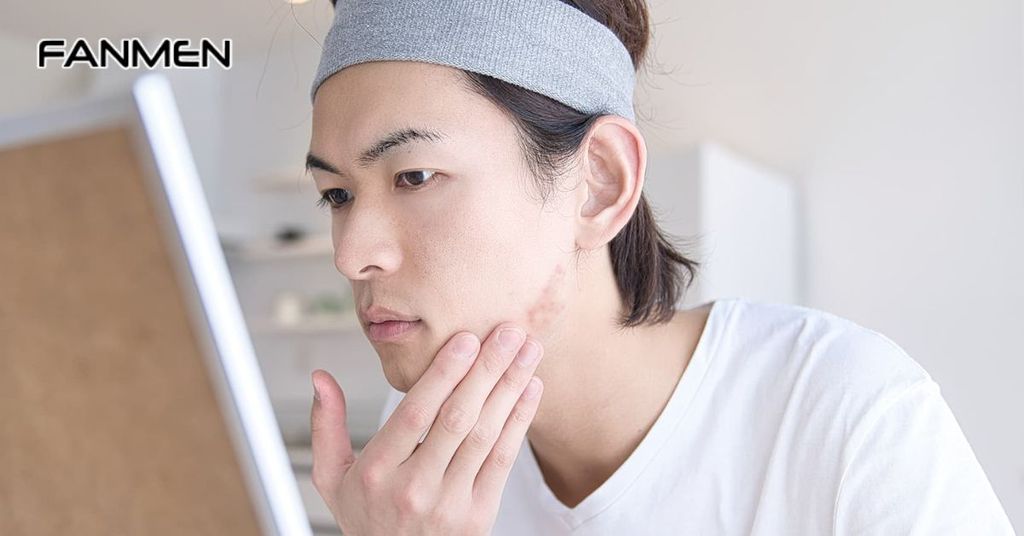 Vị trí mụn trên quai hàm