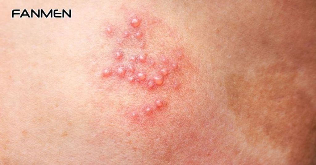 Mụn rộp sinh dục