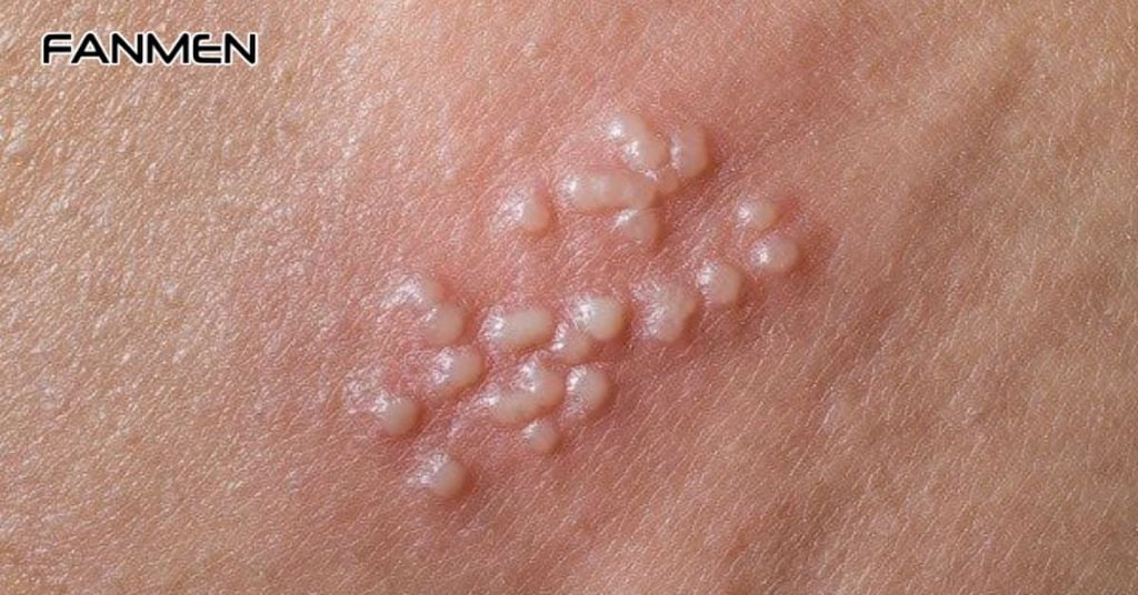 Mụn rộp sinh dục là gì