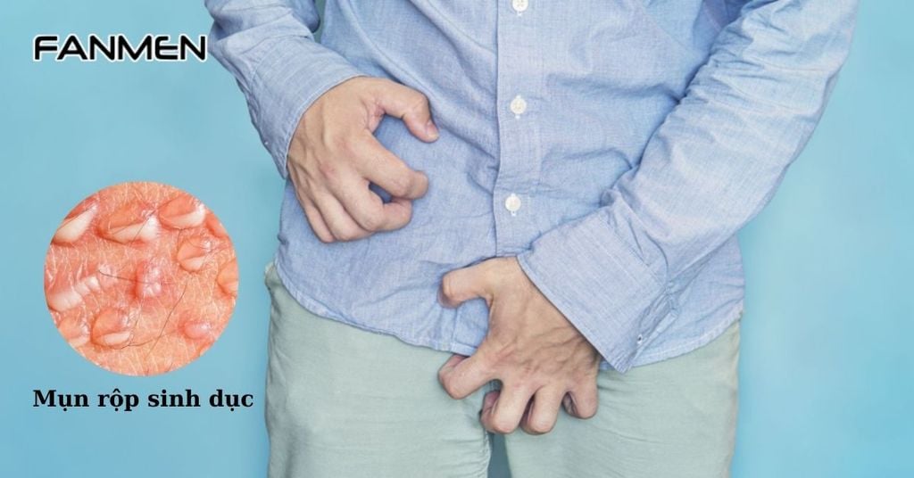 Mụn rộp sinh dục