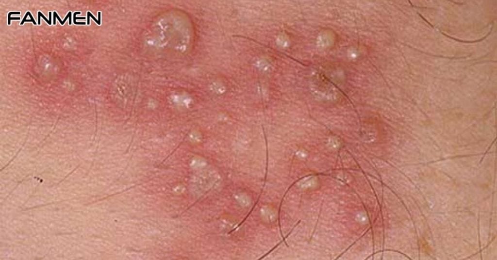 Mụn rộp sinh dục