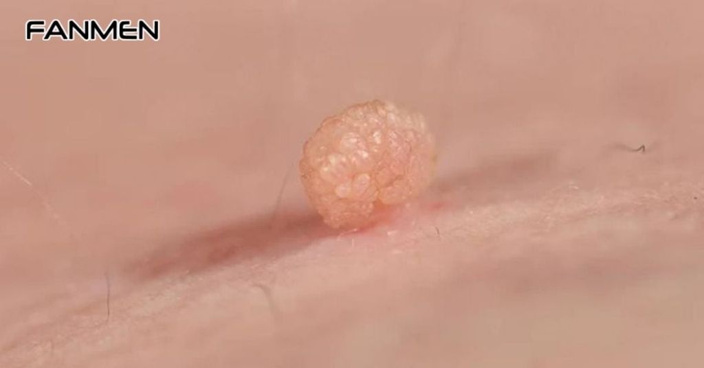 Mụn thịt lành tính