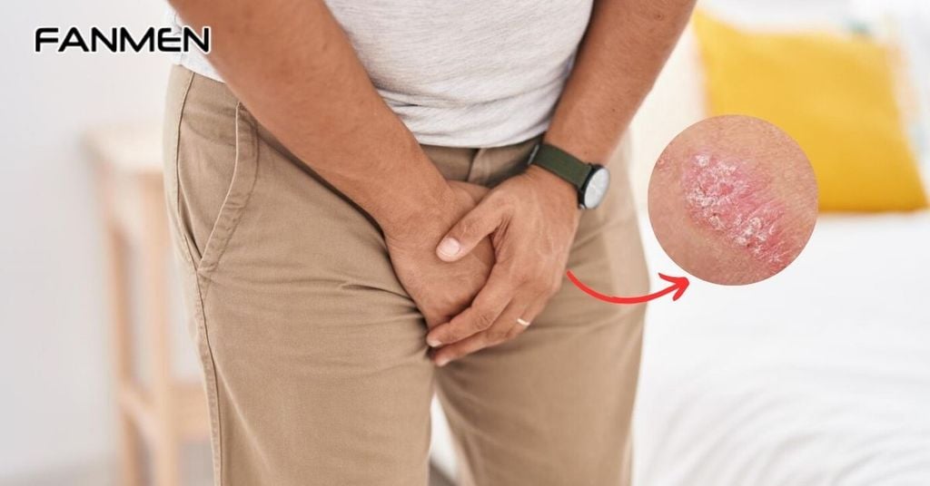 Dấu hiệu nhận biết nấm vùng kín ở nam giới