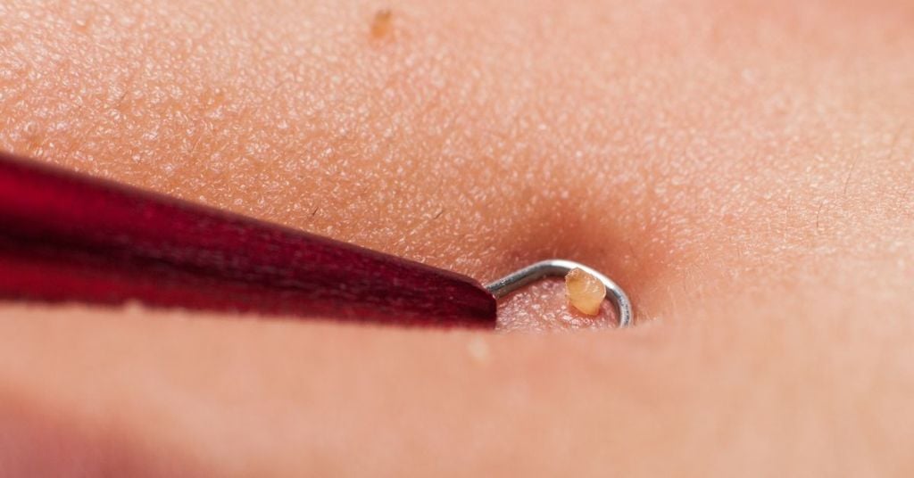 cách trị mụn đầu đen ở mũi cho nam