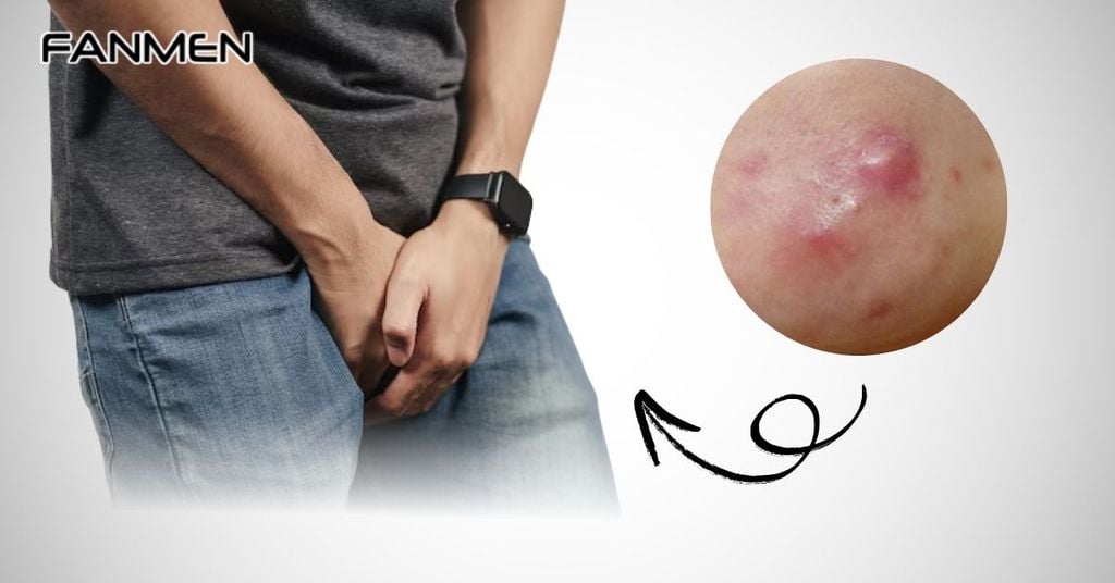 Nguyên Nhân Mọc Mụn Bọc Ở Vùng Kín Nam Giới
