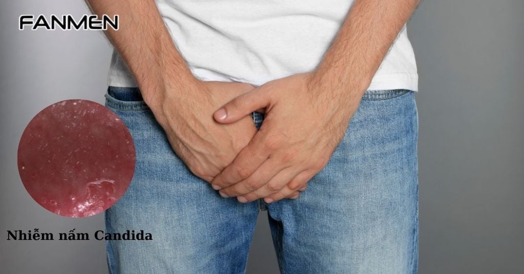 Ngứa rát vùng kín nam do nhiễm nấm Candida
