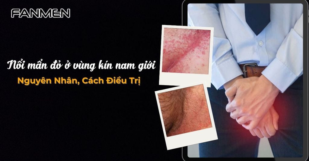 Nổi mẩn đỏ ở vùng kín nam giới