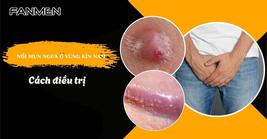 nổi mụn ngứa ở vùng kín nam