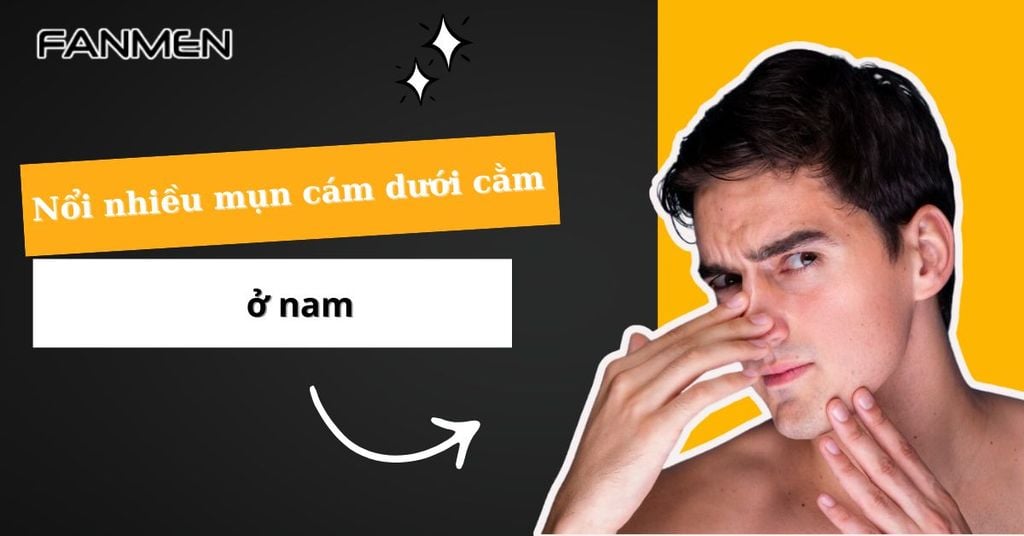 Nổi nhiều mụn cám dưới cằm ở nam