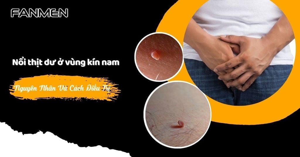 Nổi thịt dư ở vùng kín nam