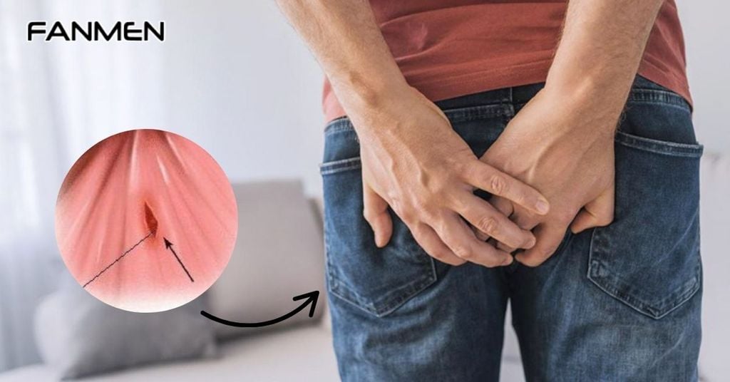 Nứt kẽ hậu môn