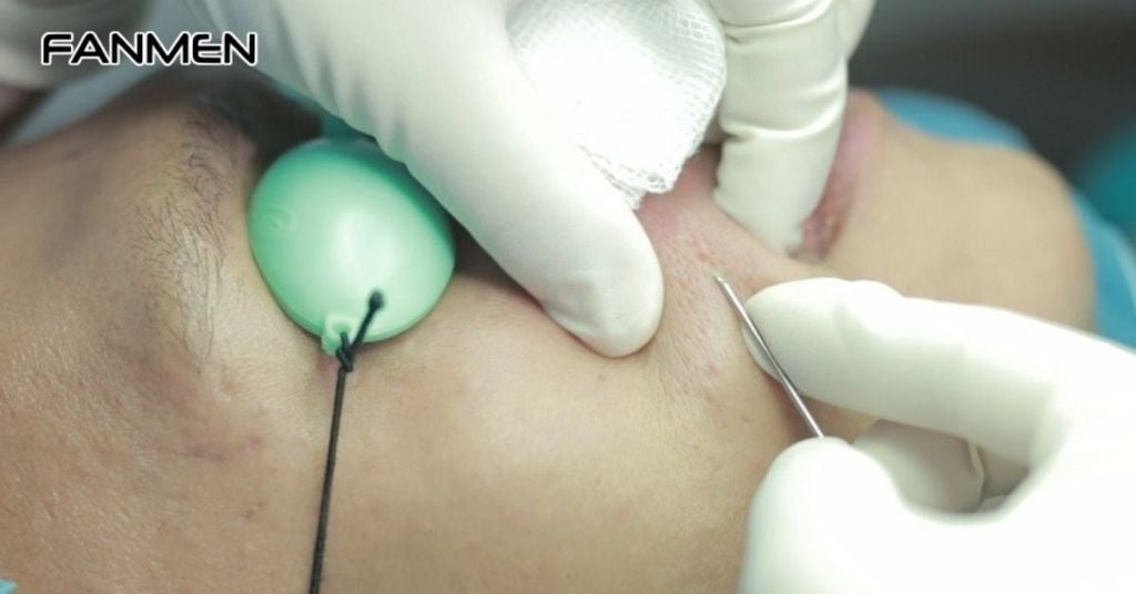 Phương pháp bóc tách sẹo