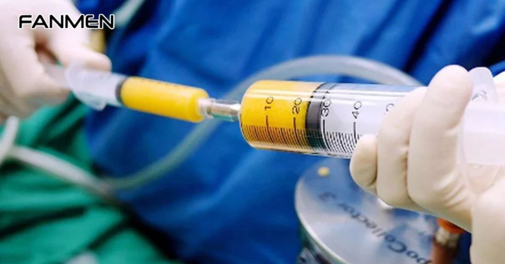 Phương pháp cấy mỡ tự thân