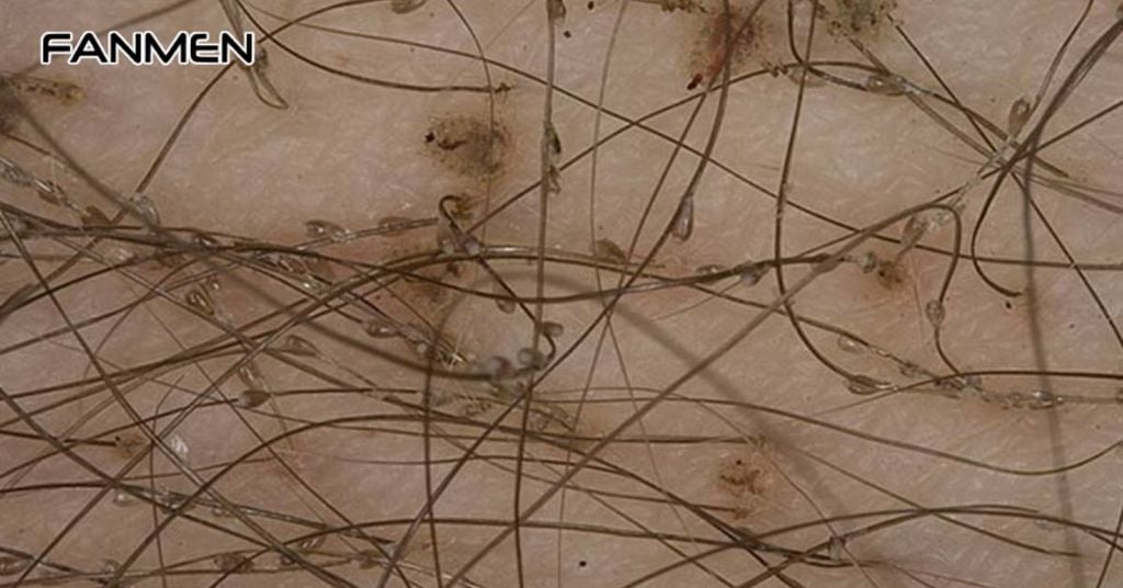 Rận mu (rận lông mu)