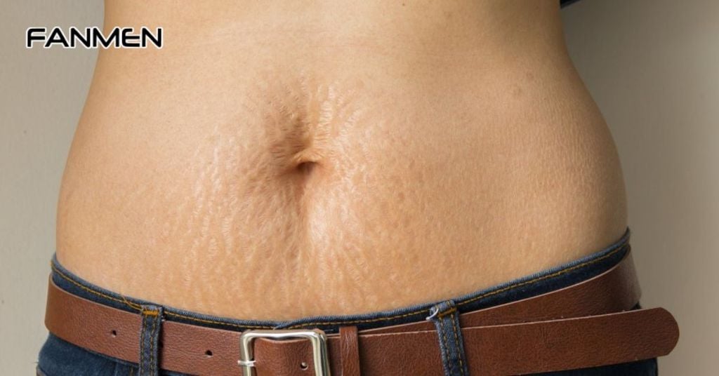 Dạn nứt da do tuổi dậy thì