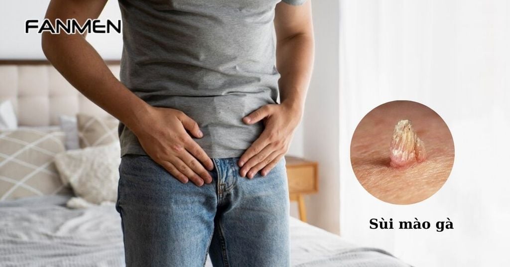 Nổi mụn cứng ở vùng kín nam giới do sùi mào gà