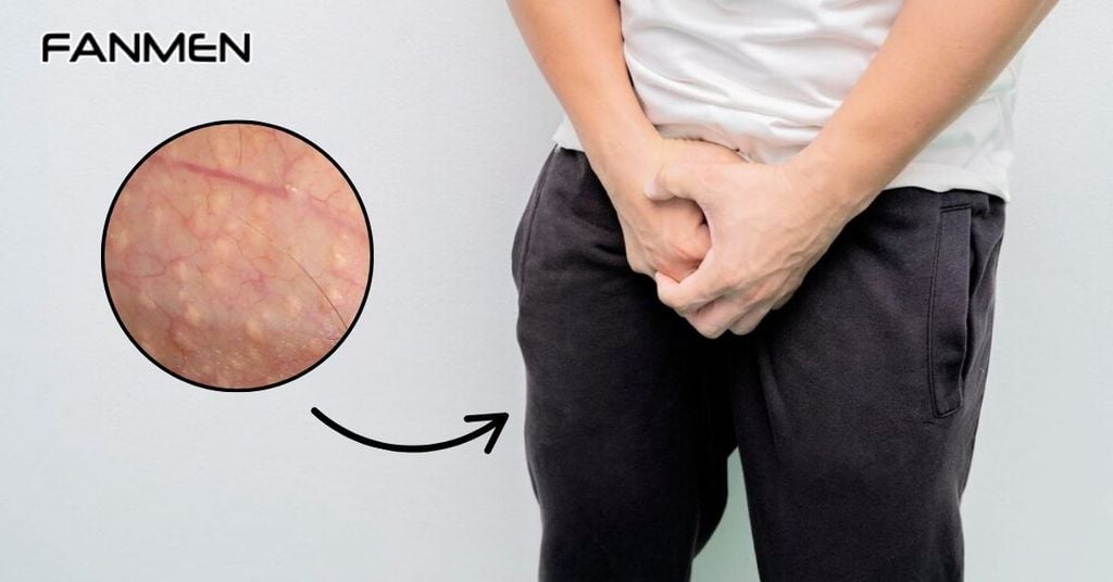 Hạt Fordyce Ở Vùng Kín Nam Có Sao Không?